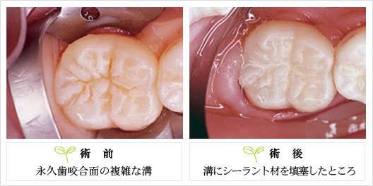 シーラントでむし歯予防 神戸東灘区岡本 摂津本山のだ歯科医院
